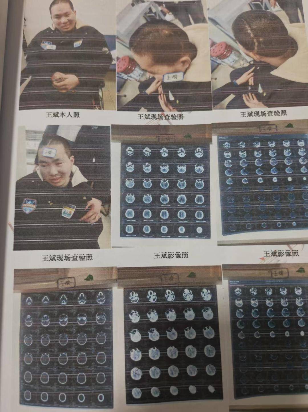 被撞碎的人生：23岁研究生被16岁少年无证驾车撞致颅脑损伤，亲属称其如今心智如幼童